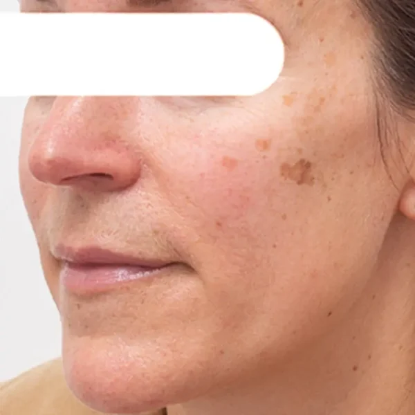 Cheemex® Herbal Spots Peel-Off Facial Mask