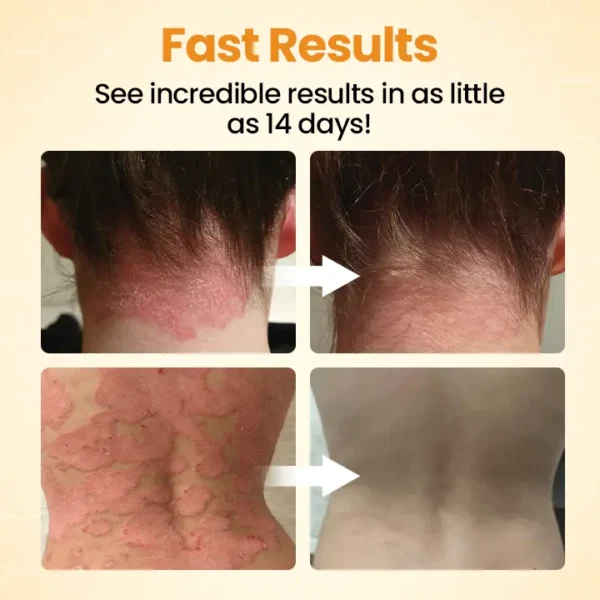 [Official Authorized Store] Cheemex®BeeLieves Psoriasis Skin Care