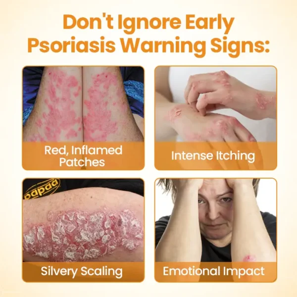 [Official Authorized Store] Cheemex®BeeLieves Psoriasis Skin Care