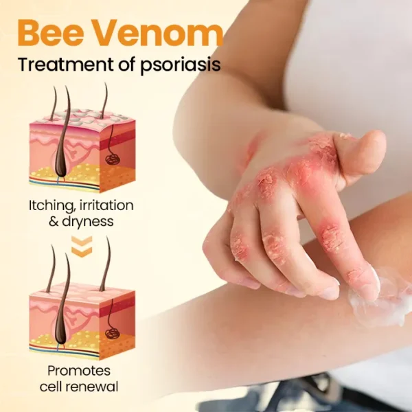 [Official Authorized Store] Cheemex®BeeLieves Psoriasis Skin Care