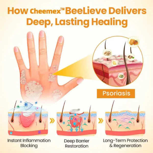 [Official Authorized Store] Cheemex®BeeLieves Psoriasis Skin Care