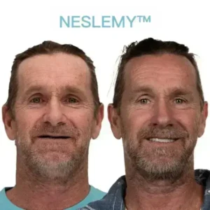 NESLEMY™ GelFit Dentures