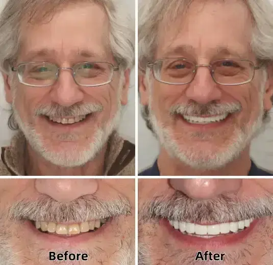 SmileFitPro™–Advanced Custom-Fit Functional Dentures