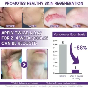 Acezozla® ReGenScar Stem Cell Scar Gel