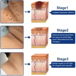 ✨😍Celsiora® Targeted Skin Tag & Wart Removal Cream – Time-Released Phyto-Exfoliant (12% Celandine ) & Bio-Active Terpene Viral-Inhibitor (8% Thuja)