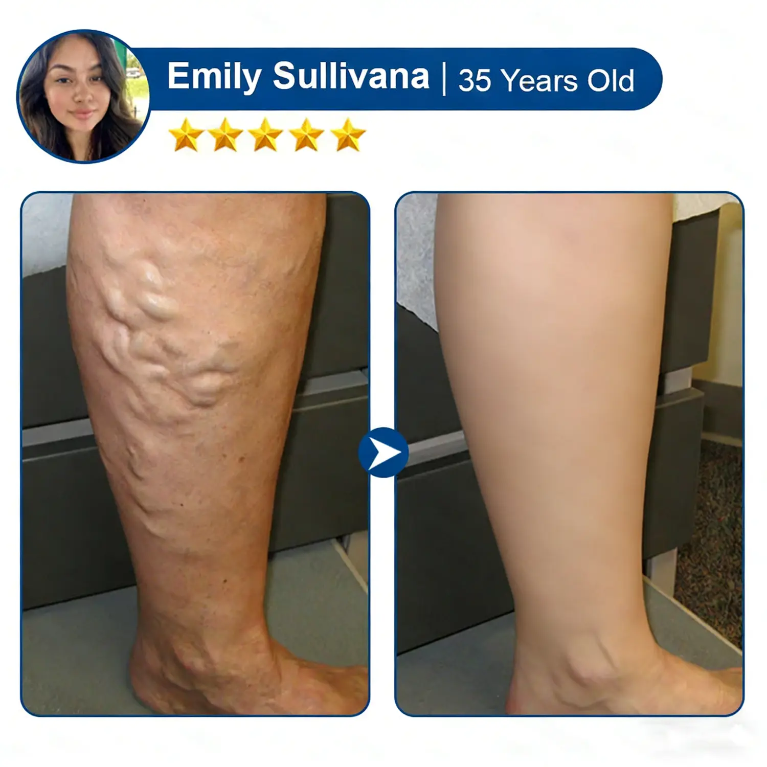 Cheemex® Vein Contour Microneedle