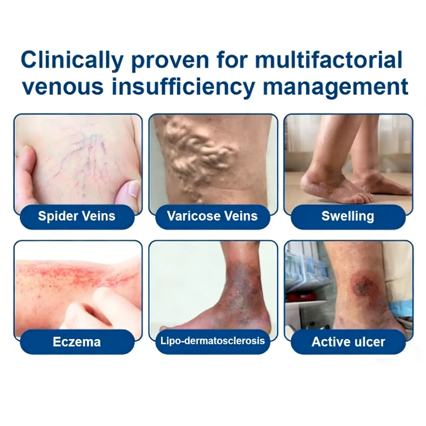 Cheemex® Vein Contour Microneedle