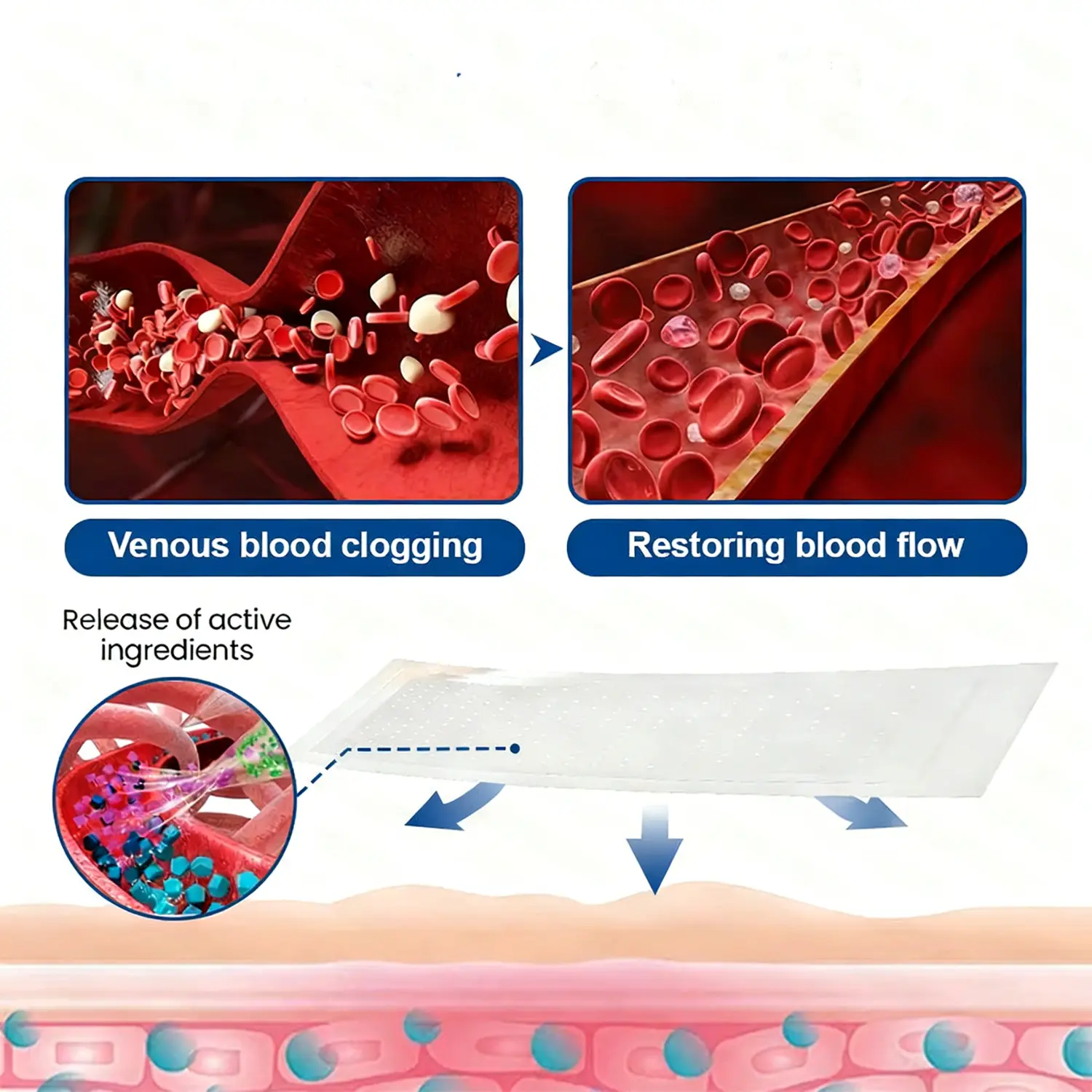 Cheemex® Vein Contour Microneedle