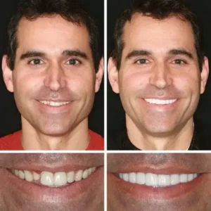 🦷Custom-Fit Dentures | Smile with Confidence