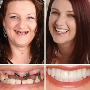 -Ends Today: 70% OFF! ⏰HazyGalaxy™ Medical Full Denture with Strong Suctiond Custom-Fit Full Functional Dentures🦷