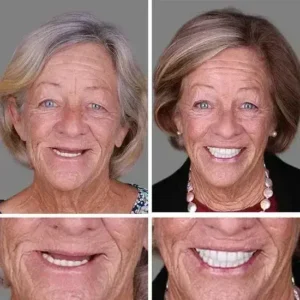 ⏰Ends Today: 70% OFF! 🌎KLENIMORE™ Custom-Fit Dentures— Designed for Comfort and a Natural-Looking Smile