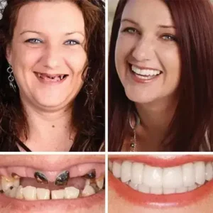 ⏰Ends Today: 70% OFF! 🌎KLENIMORE™ Custom-Fit Dentures— Designed for Comfort and a Natural-Looking Smile