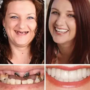 –Ends Today: 75% OFF! ⏰DarkFairy™ Medical Full Denture with Strong Suctiond Custom-Fit Full Functional Dentures🦷