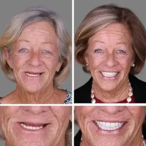 Jakhuors® Premium Denture 2026 | Custom Fit Denture